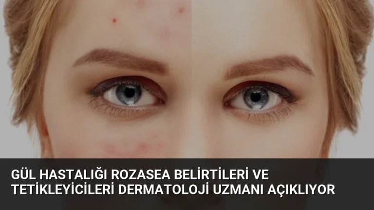Gül Hastalığı Rozasea Belirtileri ve Tetikleyicileri Dermatoloji Uzmanı Açıklıyor