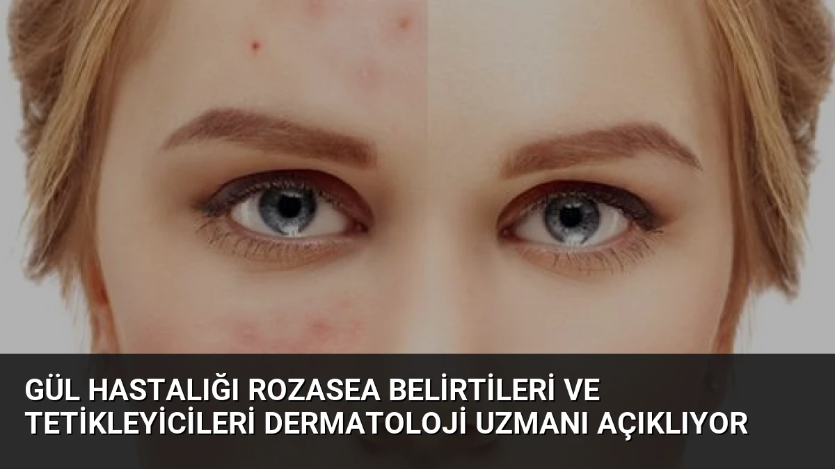 Gül Hastalığı Rozasea Belirtileri ve Tetikleyicileri Dermatoloji Uzmanı Açıklıyor