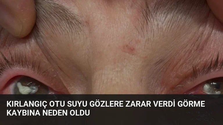 Kırlangıç Otu Suyu Gözlere Zarar Verdi Görme Kaybına Neden Oldu